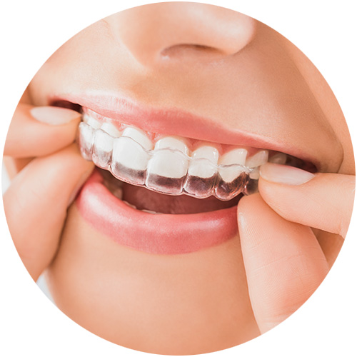 Fissure Seals Fissure Seals