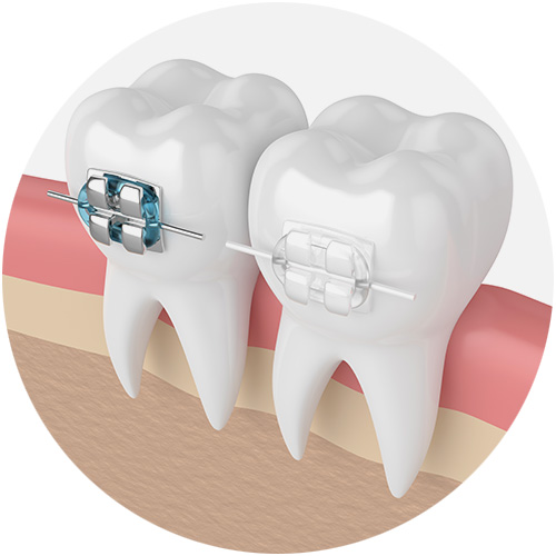 Fissure Seals Fissure Seals